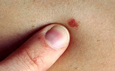 Bacakta Sivilce Belirtileri ve Tedavisi